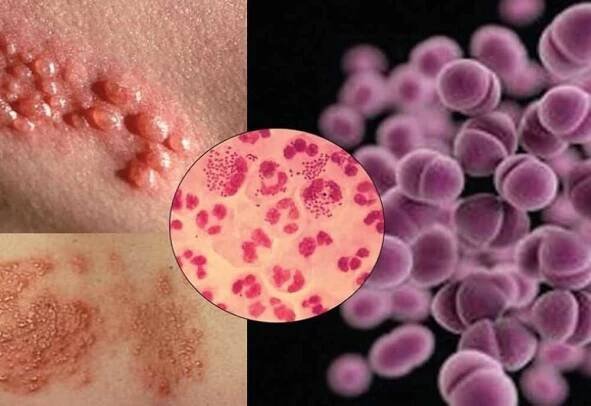 Gonorrhea u žen, rysy průběhu a specificita terapie / Články