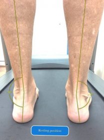 Ankle and Knee Pain when Running Downhill