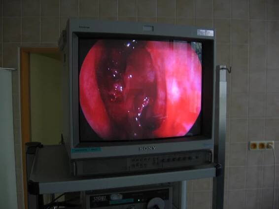 Endoskopické operace nosních dutin pro záněty a nosní polypy (FESS)