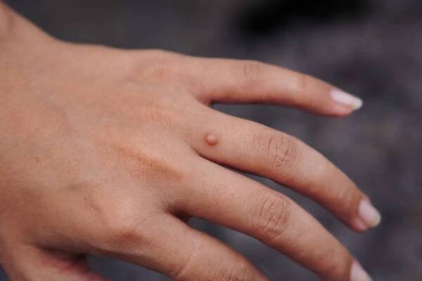finger wart on hand. health concept. body wart - papilom - stock snímky, obrázky a fotky