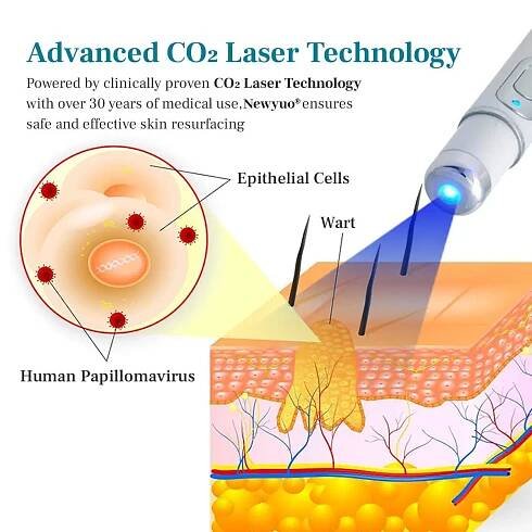 Laserové pero na odstranění znamének a bradavic Newyuo® LumeSkin