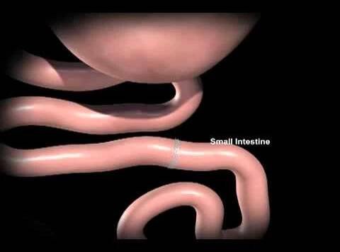 Profilový obrázek - Bypass gastrique : animation de la pose d'un bypass