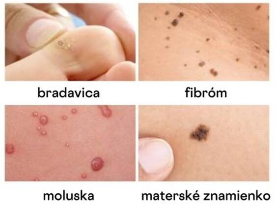 Majú bradavice korene? | ENEO