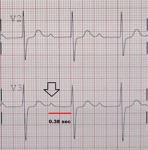 First-degree atrioventricular block