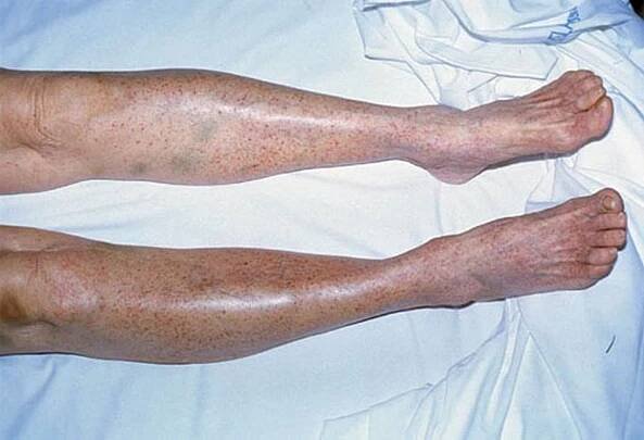 Petechiae (Skin)