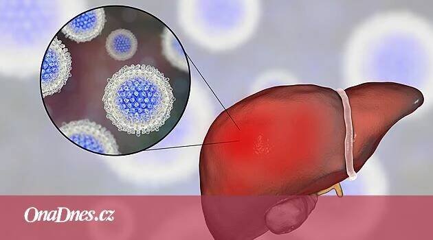 Zákeřná žloutenka typu C číhá i na dovolené, příznaky nemusíte mít roky - iDNES.cz