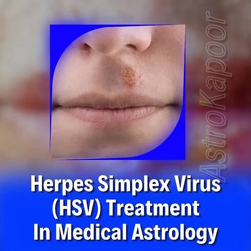 Herpes Simplex Virus (HSV) Treatment In Medical Astrology Image