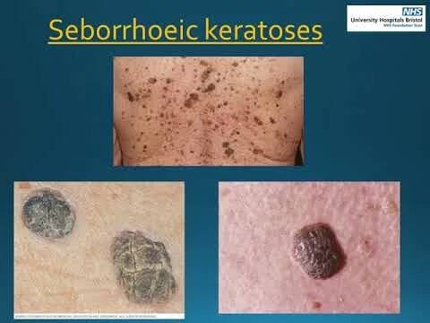 Skin cancer education