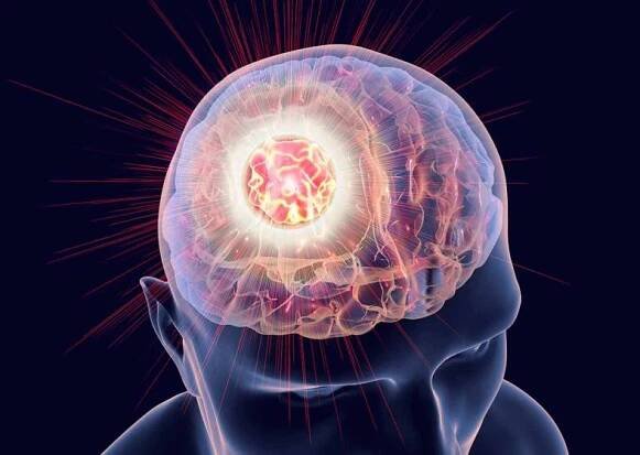 Illustration of brain cancer