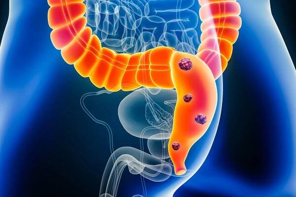 rakovina konečníku nebo kolorektálního karcinomu s orgány a rakovinnými buňkami 3d vykreslení ilustrace s mužským tělem. anatomie, onkologie, střevní nebo střevní onemocnění, lékařství, biologie, věda, koncepce zdravotní péče. - konečník - stock snímky, obrázky a fotky