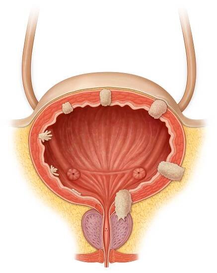 Bladder Cancer Stages