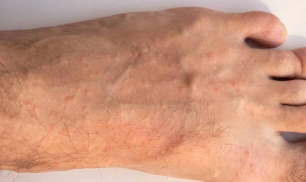 alergická reakce na nohu. vyrážka na noze. dermatologické onemocnění. pupínky na noze - svrab - stock snímky, obrázky a fotky