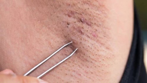 Zarůstající chloupky po holení netrápí jen ženy. Proč se to děje a jak se bolavým vřídkům vyhnout?