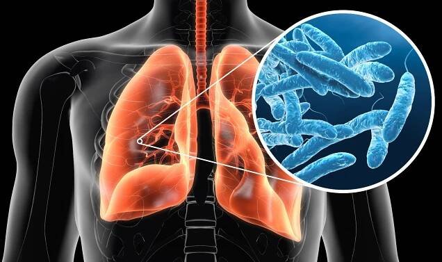 Jak vzniká legionella - Příznaky a její léčba