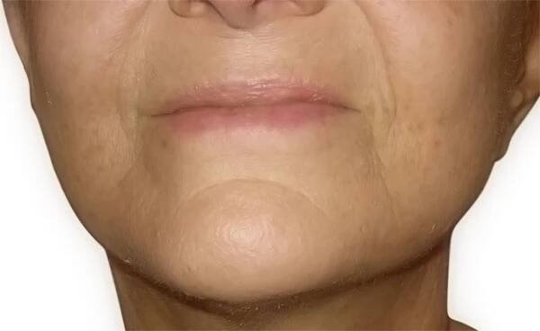 Lifting obličeje – facelift | Perfect Clinic