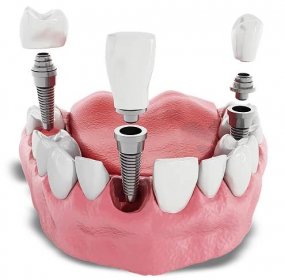 Dental Implant Options – Pagosa Dental Implant Center