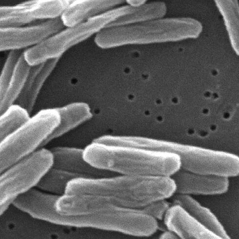 Tuberculosis cases in the US rose to their highest levels in more than a dozen years