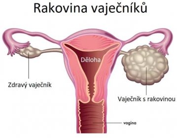 Rakovina vaječníků - ilustrace