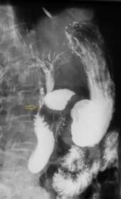 Obrázek 5A,B - Dvojkontrastní RTG vyšetření v hypotonii u pacientky se sekundární stenózou orální části sestupné kličky duodena při infiltraci přerůstajícím adenokarcinomem hlavy pankreatu