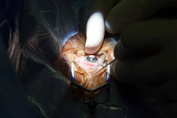 Unikátní operace šedého zákalu. Laser je 10x přesnější