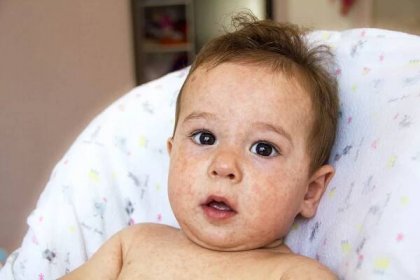 Dítě s problémem dermatitida, vyrážka. Alergií trpí potravinovými alergiemi. Detail atopické příznaku na pokožku tváře. koncepce — Stock obrázek