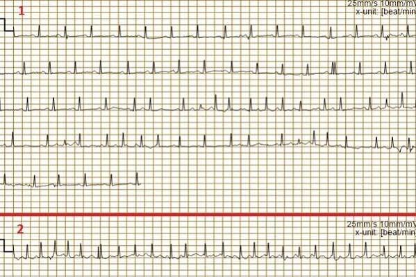 Bušení srdce po vyšší dávce léků - Mezinárodní centrum pro telemedicínu