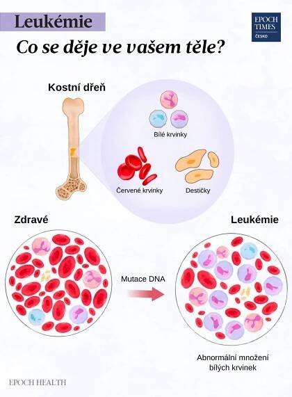 Leukémie: Příznaky, příčiny, léčba a přírodní přístupy