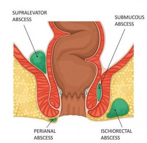 anální absces - absces trauma stock ilustrace