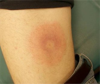 Annular Lesions: Diagnosis and Treatment | AAFP
