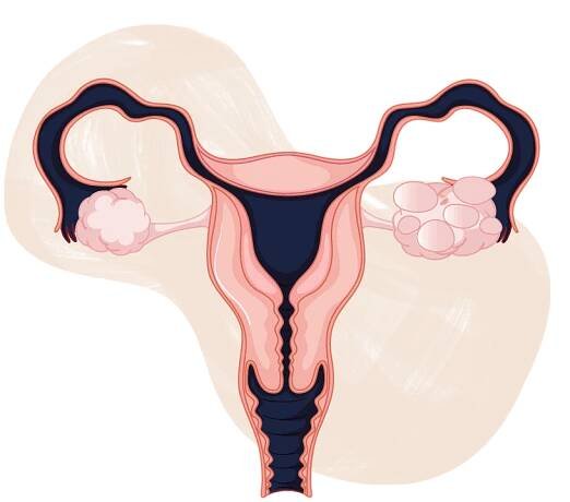 Symptoms, Causes, and Treatments of Polycystic Ovary Syndrome (PCOS) - Today's Women