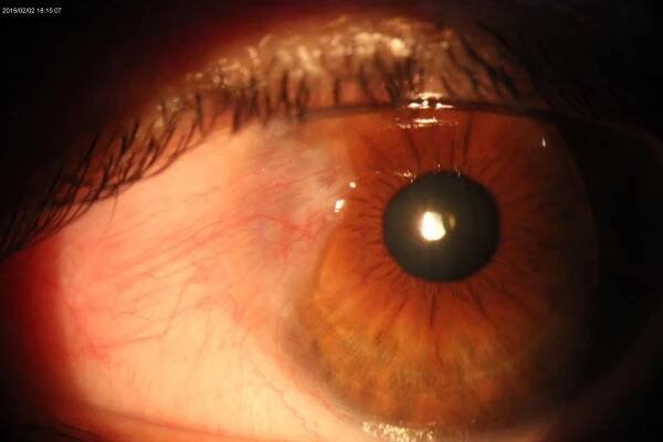 Pterygium removal: PANIS method