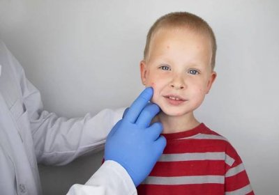 alergik nebo dermatolog zkoumá červené skvrny na obličeji dítěte. chlapec trpí vyrážkou, kopřivkou a svěděním. potravinová alergie, kousnutí hmyzem, spalničky nebo plané neštovice - alergolog - stock snímky, obrázky a fotky