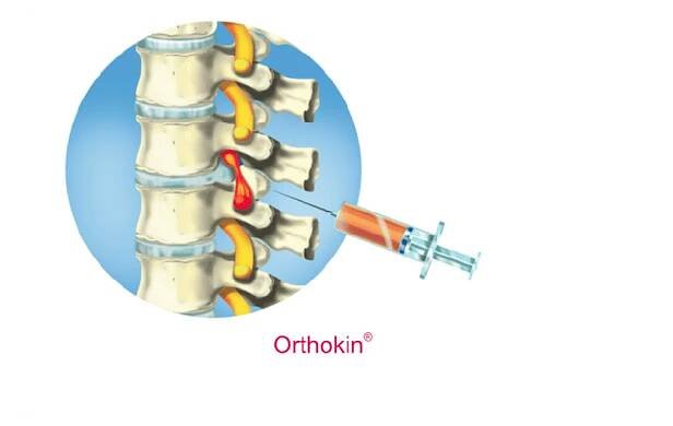 Jak funguje léčba metodou Orthokine