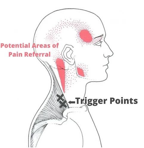Dry Needling for Neck Pain - TruMotion Therapy | Chiropractor
