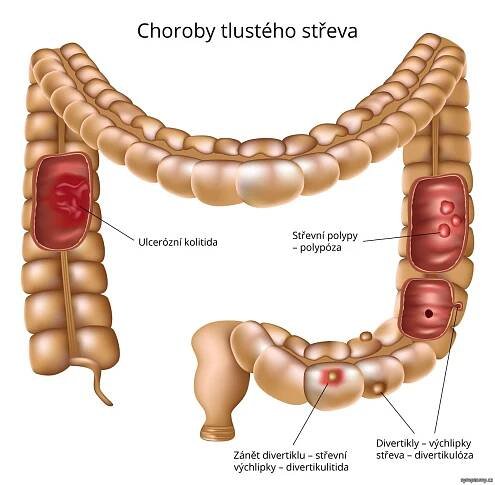 Choroby tlustého střeva (ulcerózní kolitida, střevní polypy, zánět divertiklu)