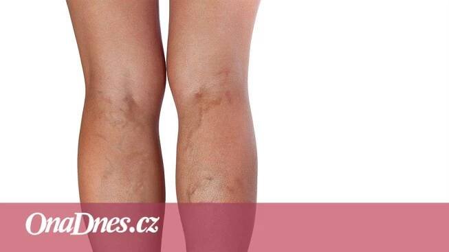 Křečové žíly jsem neřešila a vymstilo se mi to, píše čtenářka Iveta - iDNES.cz