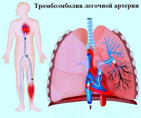 Symptomy a léčba plicních embolií / První pomoc