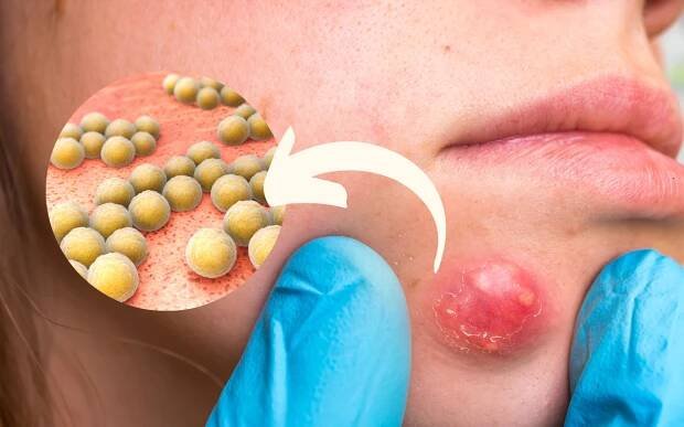 Zlatý stafylokok – príčiny infekcie, príznaky, liečba a prevencia - KAMzaKRASOU.sk