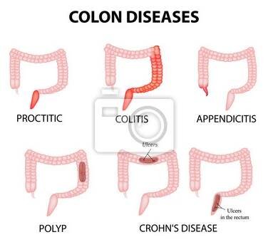 Onemocnění tlustého střeva. Proctitis, kolitida, apendicitida, polyp, vřed, Crohnova choroba. Infografika. Vektorové ilustrace na izolované pozadí