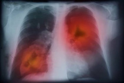 Co je chronická obstrukční plicní nemoc?