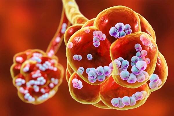 Streptococcus pneumoniae sérotyp 3 nadále nejčastějším půvo...