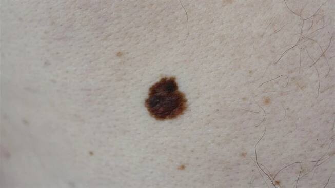 Až 50 procent melanomů vznikne na podkladě pigmentového znaménka. Na snímku je melanom hnědočerné barvy s nepravidelně rozloženým pigmentem. Okraje jsou neostré, rozpité a tvar je nepravidelný.