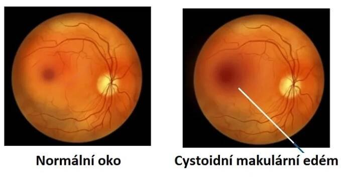 Cystoidní makulární edém je oční onemocnění, které postihuje část vaší sítnice. Nastává tehdy, když makula oteče a vytvoří se drobné puchýřky tekutiny, které vypadají jako malé cysty.