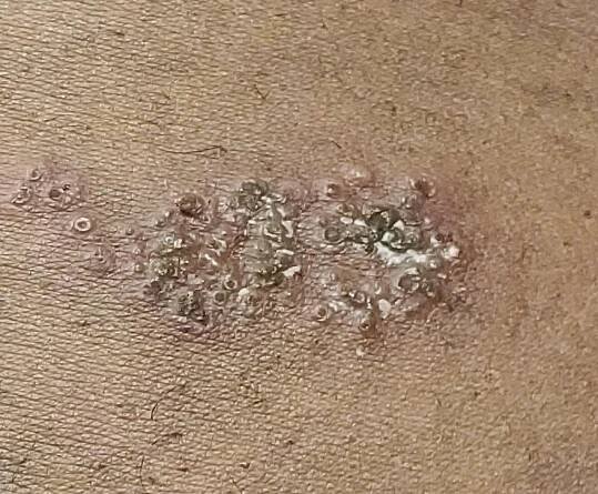 Herpes Zoster (ICD-10: B02) - Online consultation AI dermatologist