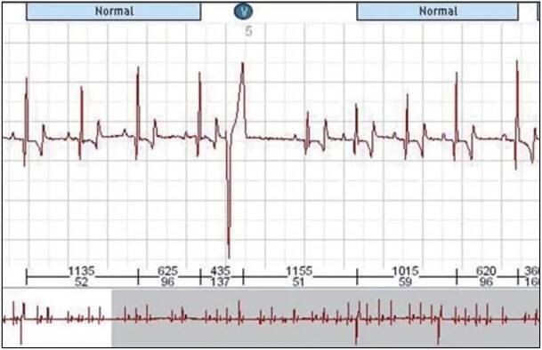 a1205-02-ekg