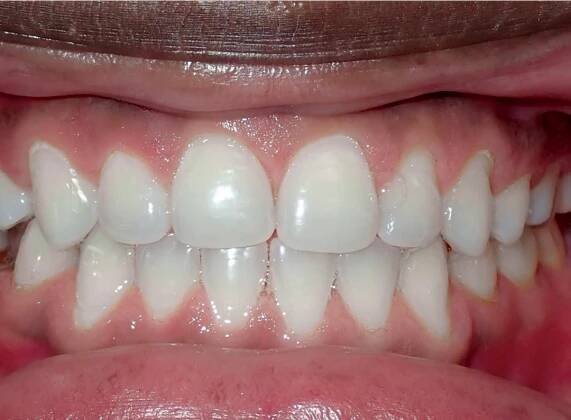 Smile Gallery - Zaytoun Orthodontics