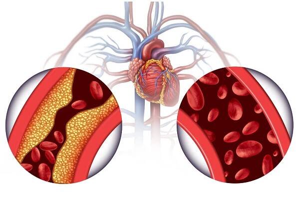 Cholesterol v žilách
