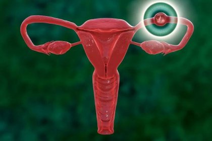 What is ectopic pregnancy?...