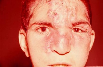 Infiltrace kůže v důsledku endemické syfilis.jpg