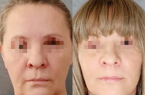 Face Lift - operace obličeje | Olomouc